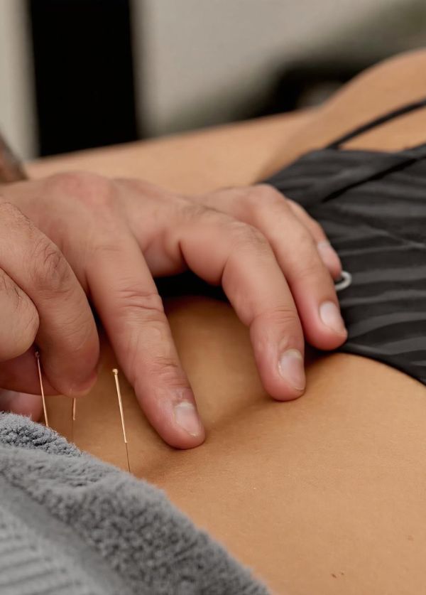 Acupuncture services by I-Physio Health & Performance